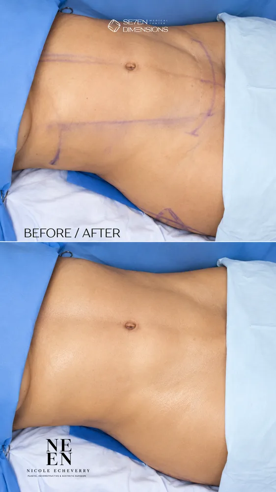 Abdominal liposuction result by Dr. Nycole Echeverry