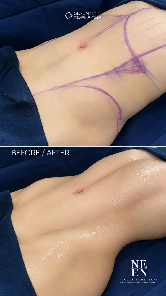Abdominal liposuction result by Dr. Nycole Echeverry