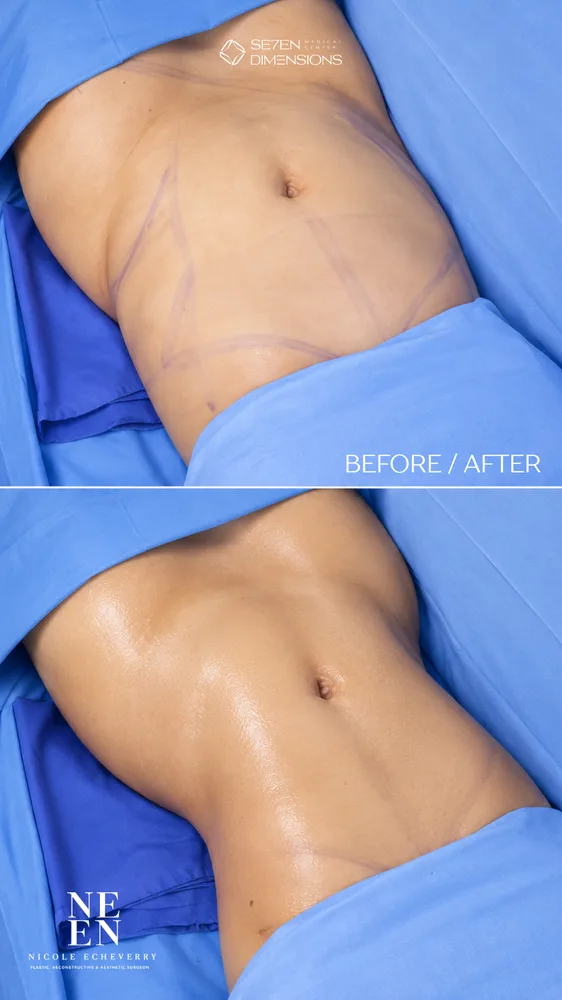 Abdominal liposuction result by Dr. Nycole Echeverry