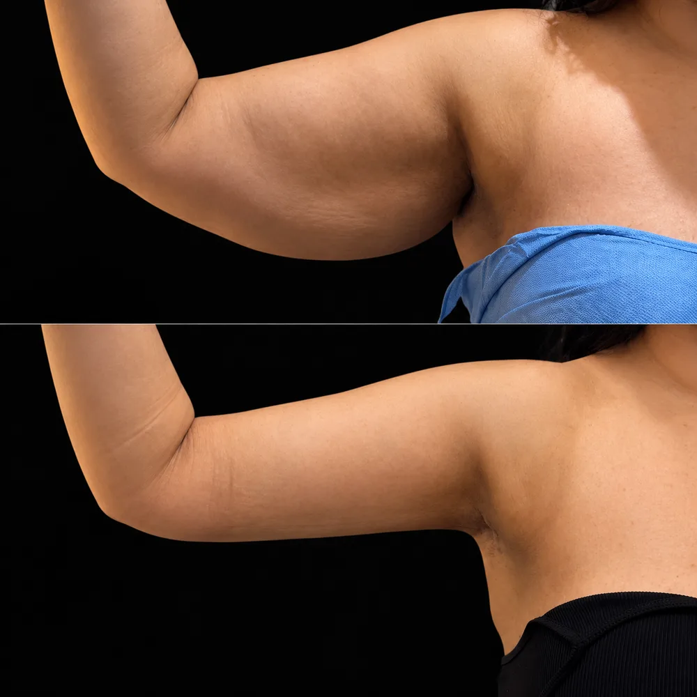 Arm contouring result by Dr. Nycole Echeverry