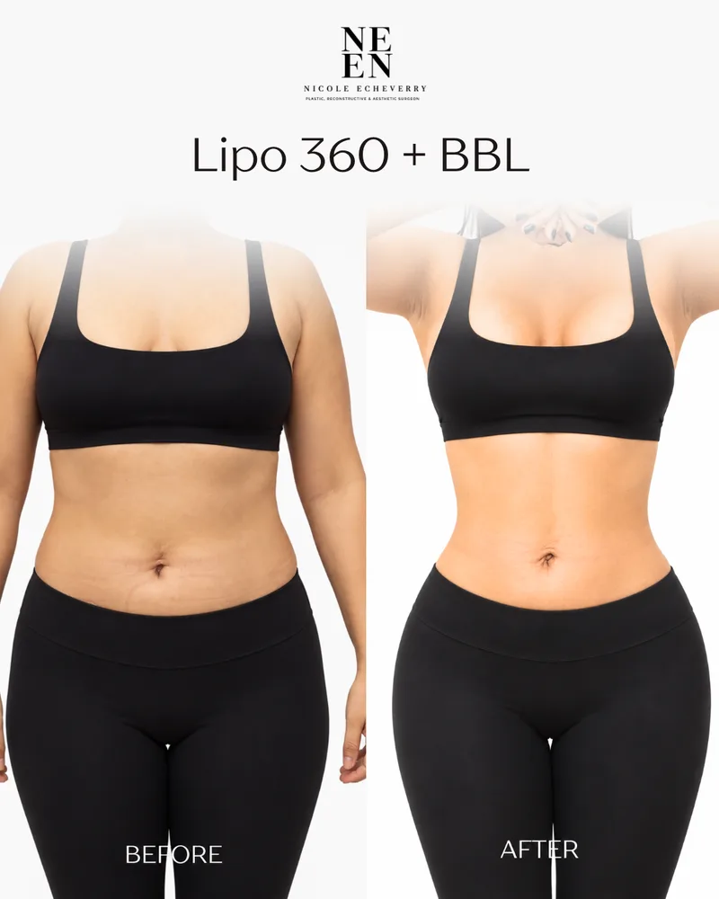 Lipo 360 + BBL result by Dr. Nycole Echeverry
