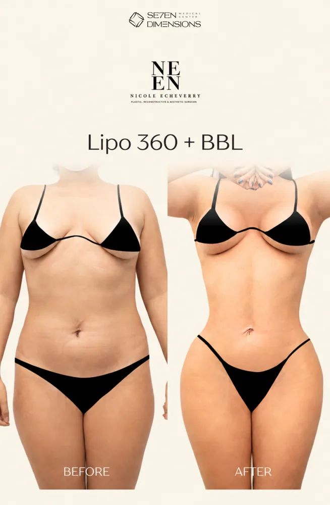 Lipo 360 + BBL result by Dr. Nycole Echeverry
