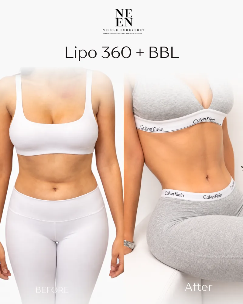 Lipo 360 + BBL result by Dr. Nycole Echeverry