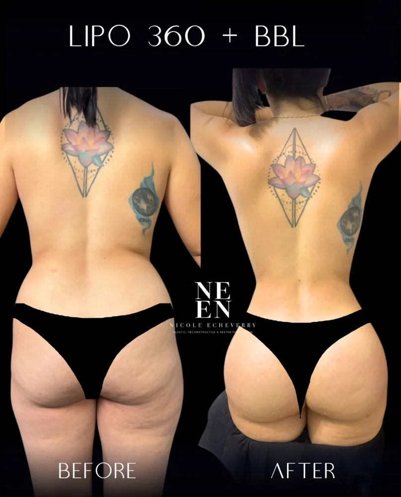 Lipo 360 + BBL result by Dr. Nycole Echeverry