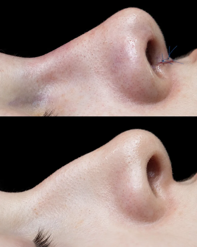 Rhinoplasty result by Dr. Nycole Echeverry