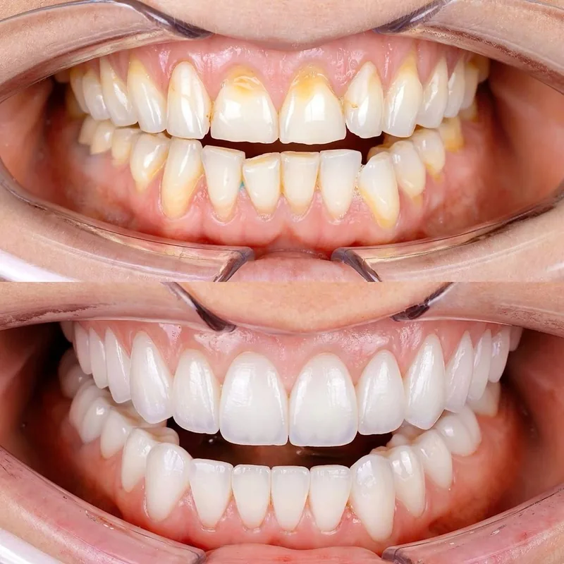 Veneers before and after, 7DMC patient case 1