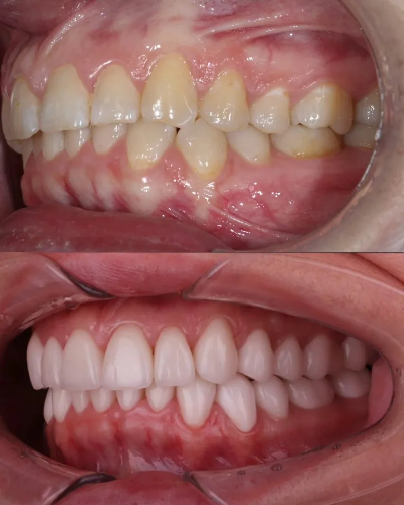 Veneers before and after, 7DMC patient case 2