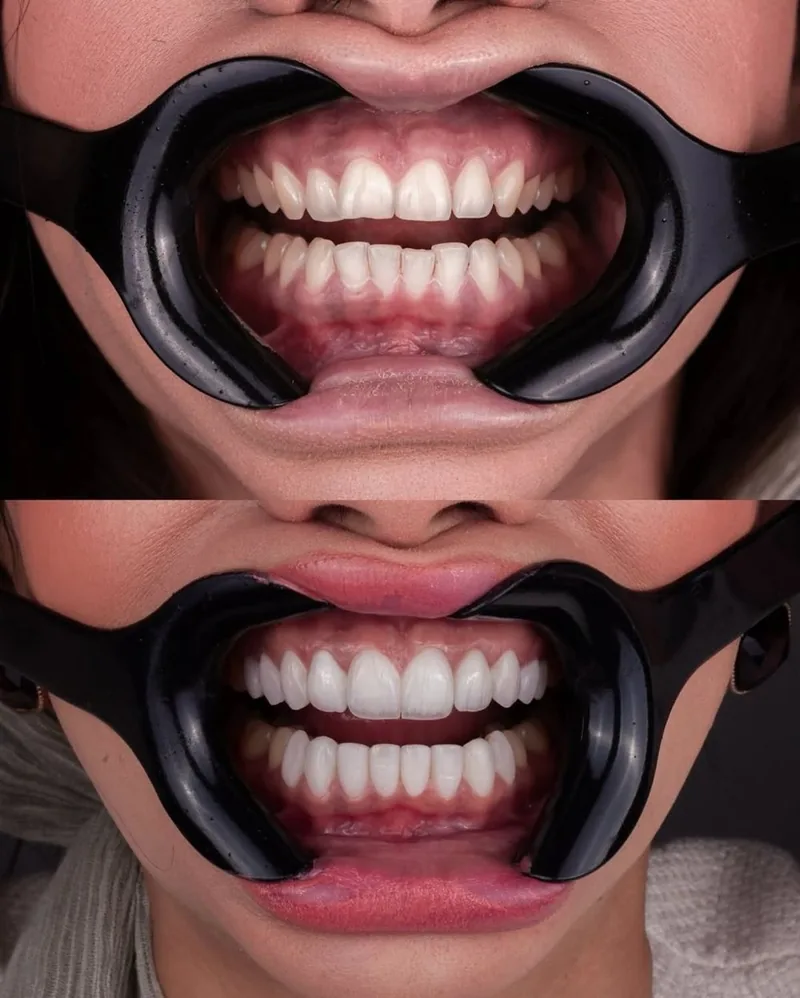 Veneers before and after, 7DMC patient case 3
