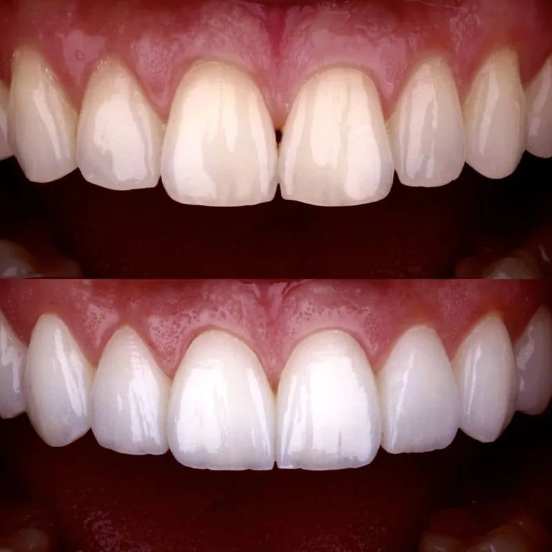 Veneers before and after, 7DMC patient case 5
