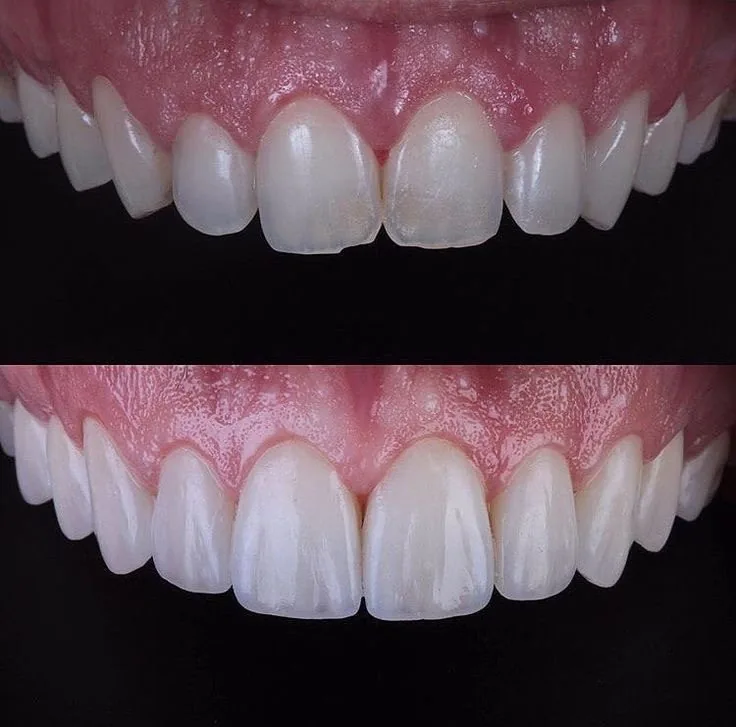 Veneers before and after, 7DMC patient case 6