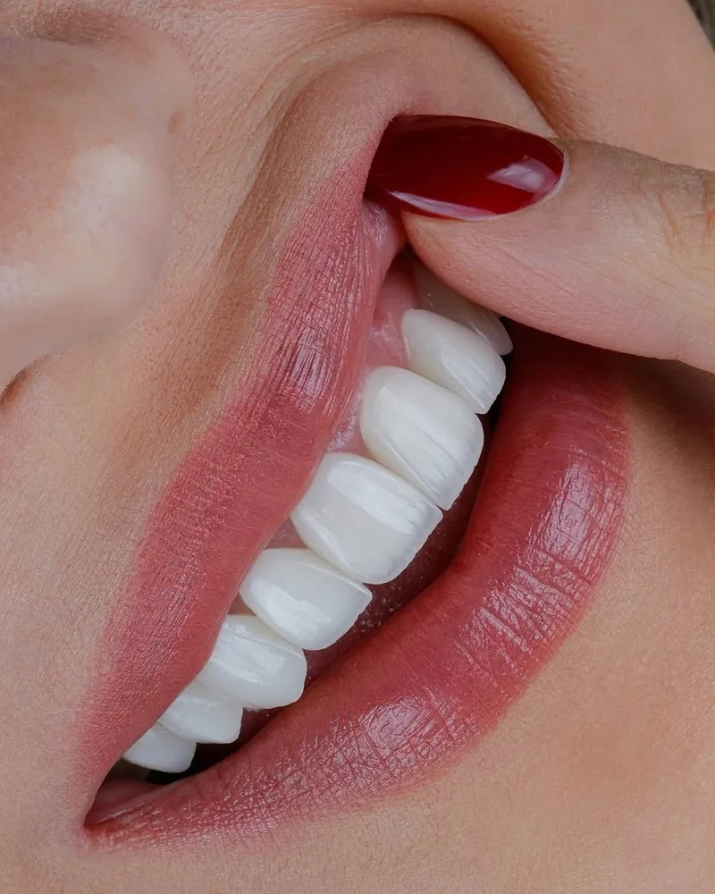 Natural-looking veneers smile, 7DMC patient case