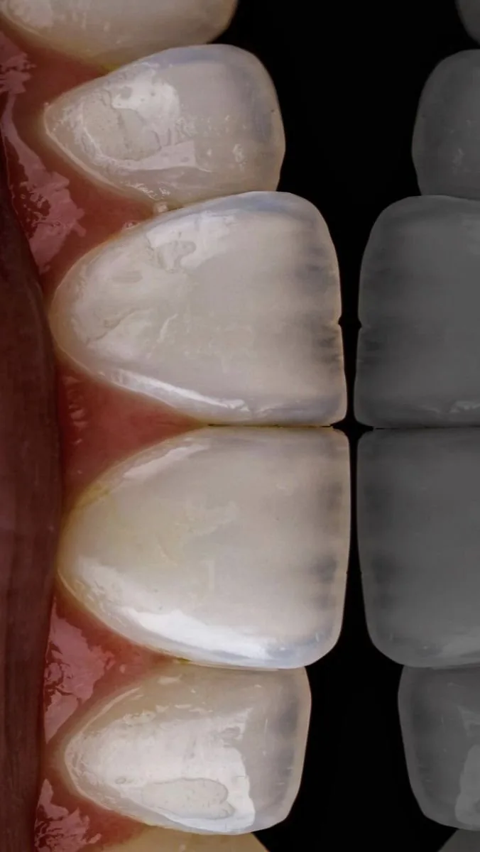 Ultra-thin veneers, 7DMC patient case